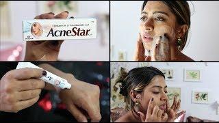 Acnestar Gel Review _ HOW TO REALLY GET RID OF ACNE | SuperWowStyle Prachi