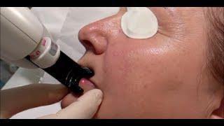 Lip Venous Lake Blemish - Laser Removal Demo at our London Clinic