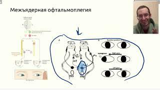 Содружественное движение глаз  Межъядерная офтальмоплегия