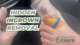 HIDDEN Ingrown Toenail Removal