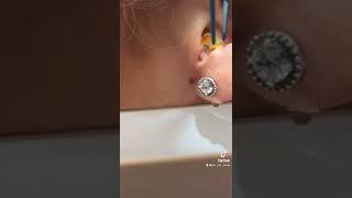 It just didn’t want to see the light -  #earwax #earwaxremoval #theearnurse #earskin