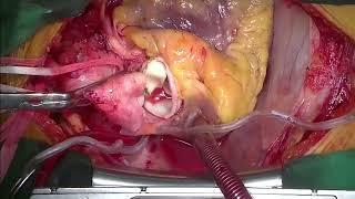 Total Arch Replacement for chronic type B dissection