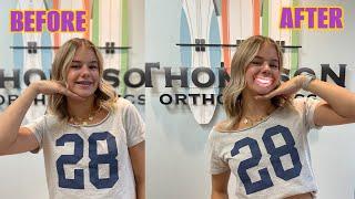 Reese Gets Her Braces Off | The LeRoys