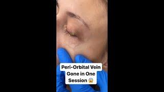 Peri-Orbital Vein Gone in One Session!