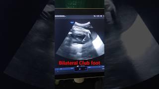 Bilateral Club foot