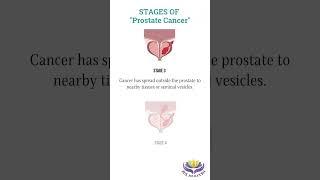 Stages of Prostate Cancer