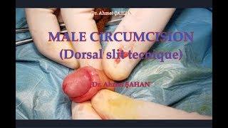 Circumcision (Dorsal slit tecnique), Erkek Çocuk Sünneti