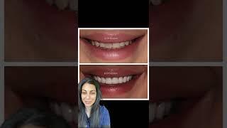 Smile makeover before and after | porcelain veneers before and after | Dr. Yazdan | #veneers