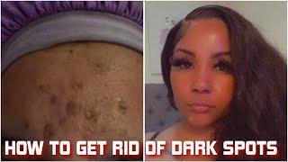 HOW TO GET RID OF DARK SPOTS IN 14 DAYS