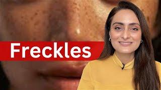 Freckles | causes | treatment | recommendations | Dermatologist