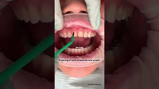 Dental veneers procedure | dental veneers before and after | Dr. Yazdan | porcelain veneers #dentist