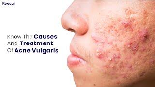 Causes And Treatment Of Acne Vulgaris