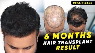 Hair Transplant in Kolkata | Best Results & Cost of Hair Transplant in Kolkata