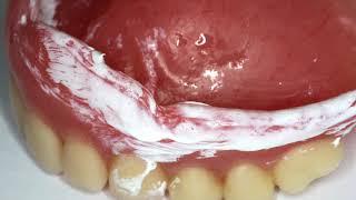 Complete Denture Base Adjustment