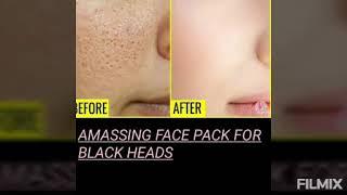 How to get rid of black heads and white heads