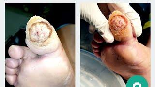 Ozone therapy in Diabetic wound , Healed in 12 days. Dr Umesh Jaiswal 9970766313