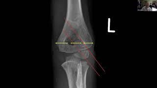 supracondylar fractures: treatment tips and tricks - Stephen Cooke