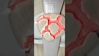 What Type of Knee Fracture Is This? (Quiz)
