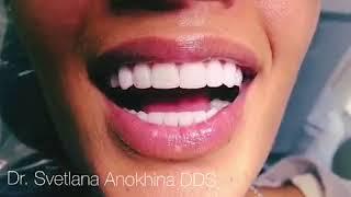 Miami Porcelain Veneers Final Result - Dr.Svetlana Anokhina DDS