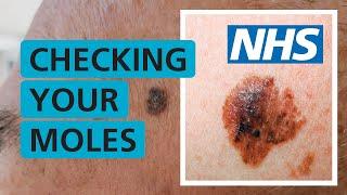 How do I check if my mole is skin cancer? | NHS