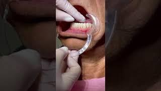 10 veneers were installed on the lower upper jaw