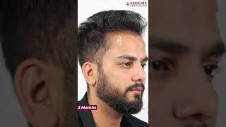 YouTuber Elvish Yadav Before & After Hair Transplant Results Update After 3 Months