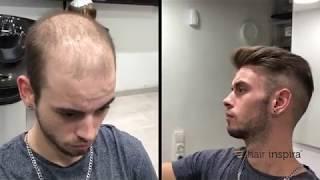 Aplicación de prótesis capilar indetectable (David) parte 2 - Hair Inspira