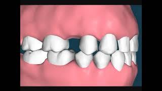 Dental Video of Drifting Teeth Premolar