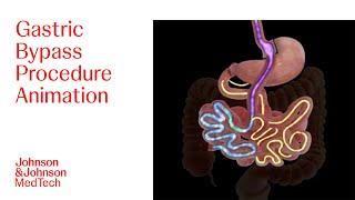 Gastric Bypass Procedure Animation | J&J MedTech