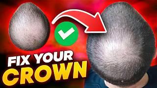 Crown Hair Loss? - Here's how to FIX a balding crown area