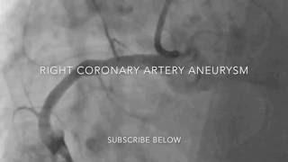 Alexandru Mischie - How would you treat this case? Right coronary aneurysm.