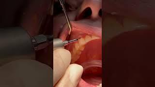 Painless teeth cleaning #shorts #dentalhygienist #oralhealth #satisfying