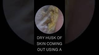 DRY EAR WAX HUSK REMOVAL