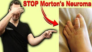 CURE Morton's Neuroma, Metatarsalgia & Ball of the Foot Pain FAST!