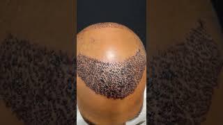 Hair transplant surgery