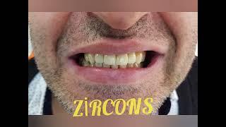 Zirconium Veneers - Dr. Serhan Aktan