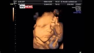 Unborn Babies 'Yawn Repeatedly Inside Womb'