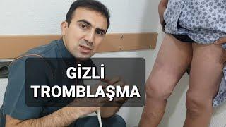 GİZLİ GEDEN TROMBLAŞMA TROMBOFLEBİT lazerle varikoz damar emeliyyati agrisiz kesiksiz tikissiz hekim