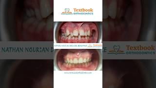 Smile transformation! Before & After with Dr. Nathan Nourian, Orthodontist in Panorama City.