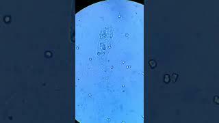 urinary cast ||what is the diagnosis?