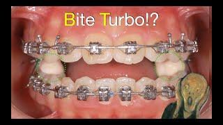 Bite Turbos：General concepts and Clinical application｜【Chris Chang Ortho】CC737