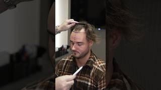 Cosmedica Clinic Hair Transplant in Turkey #shorts #hairtransplant #video