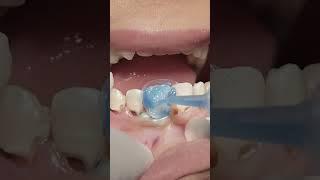 Anterior teeth composite restoration #dentist