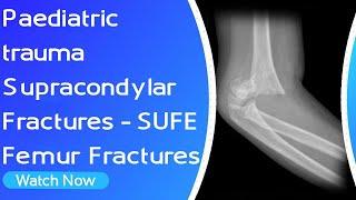 Paediatric trauma - Supracondylar Fractures | SUFE | Femur Fractures | Orthopaedic Academy