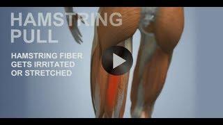 Common Sports Injuries: Hamstring Pull