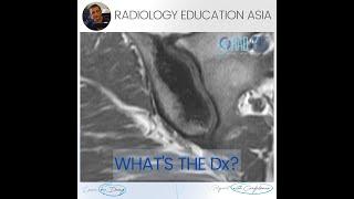 WHAT'S THE DX: OSTEITIS CONDENSANS ILII MRI