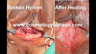 Virgin Vagina Hymen Repair Hymenoplasty Surgery in Delhi by Dr Prabhash योनि की सील बनाना