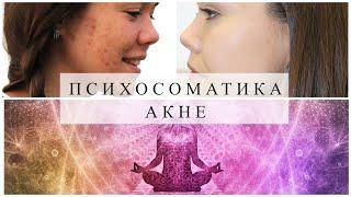 ПСИХОСОМАТИКА АКНЕ. Как избавиться от прыщей? #акне #проблемнаякожа #прыщи