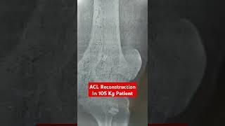 ACL Reconstruction In 105 Kg Patient.. Dr Sai Chandra