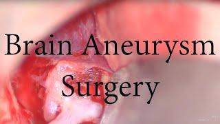 Aneurysm | brain bleeding | brain surgeries | brain operation | Dr kamran aghayev